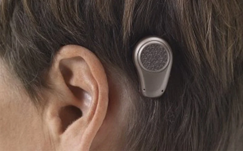 BAHA (Bone Anchored Hearing Aid)